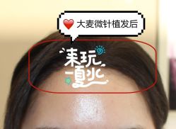 -大麦微针植发全国连锁