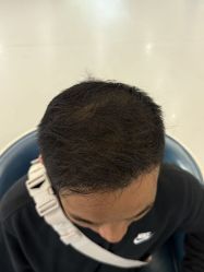 点击看大图 -大麦微针植发全国连锁