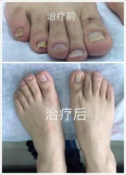 点击看大图 -德哥灰指甲脚气甲沟炎跖疣护理