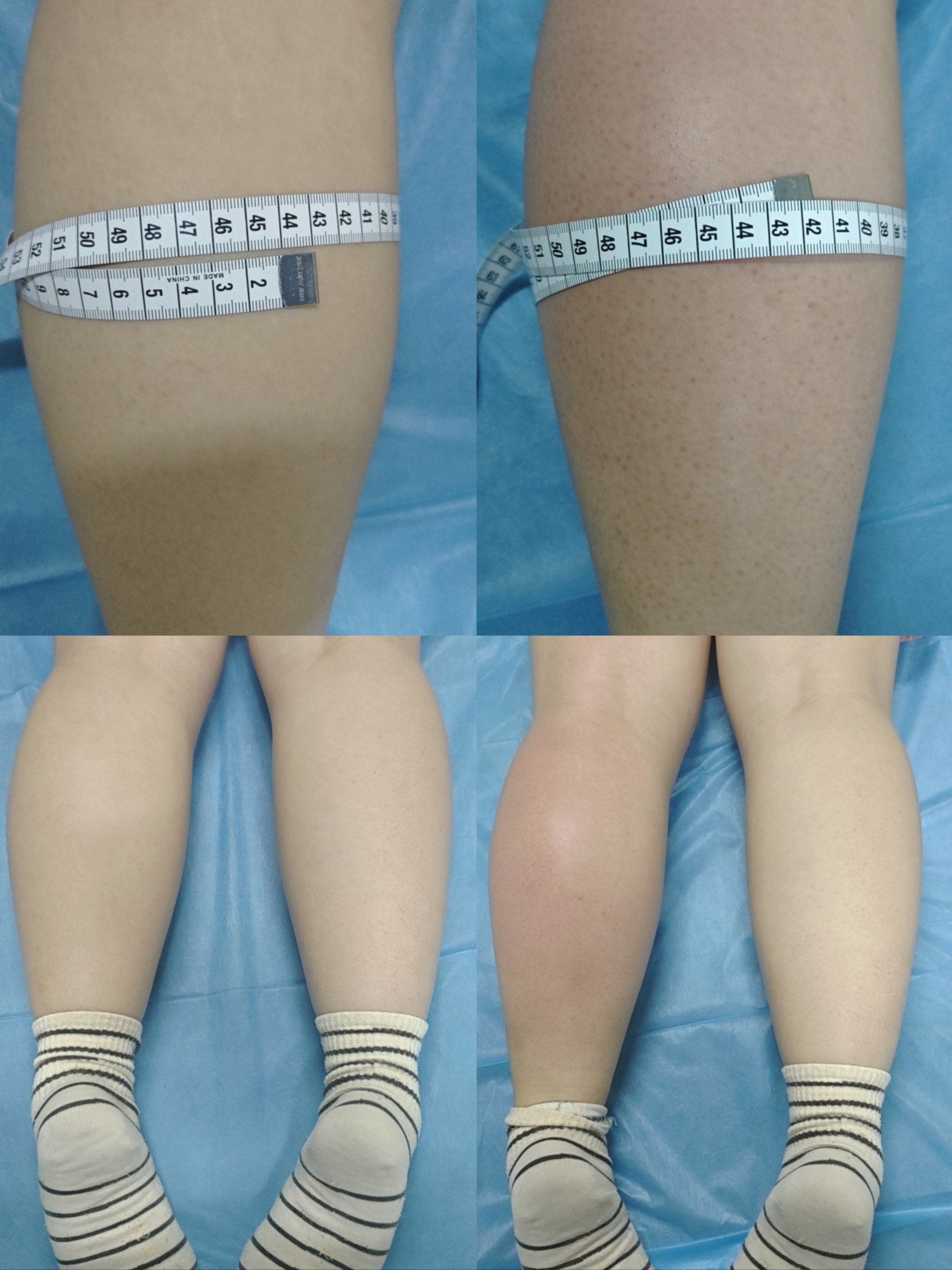 筋膜刀小腿塑形