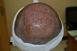 -大麦微针植发丨全国连锁