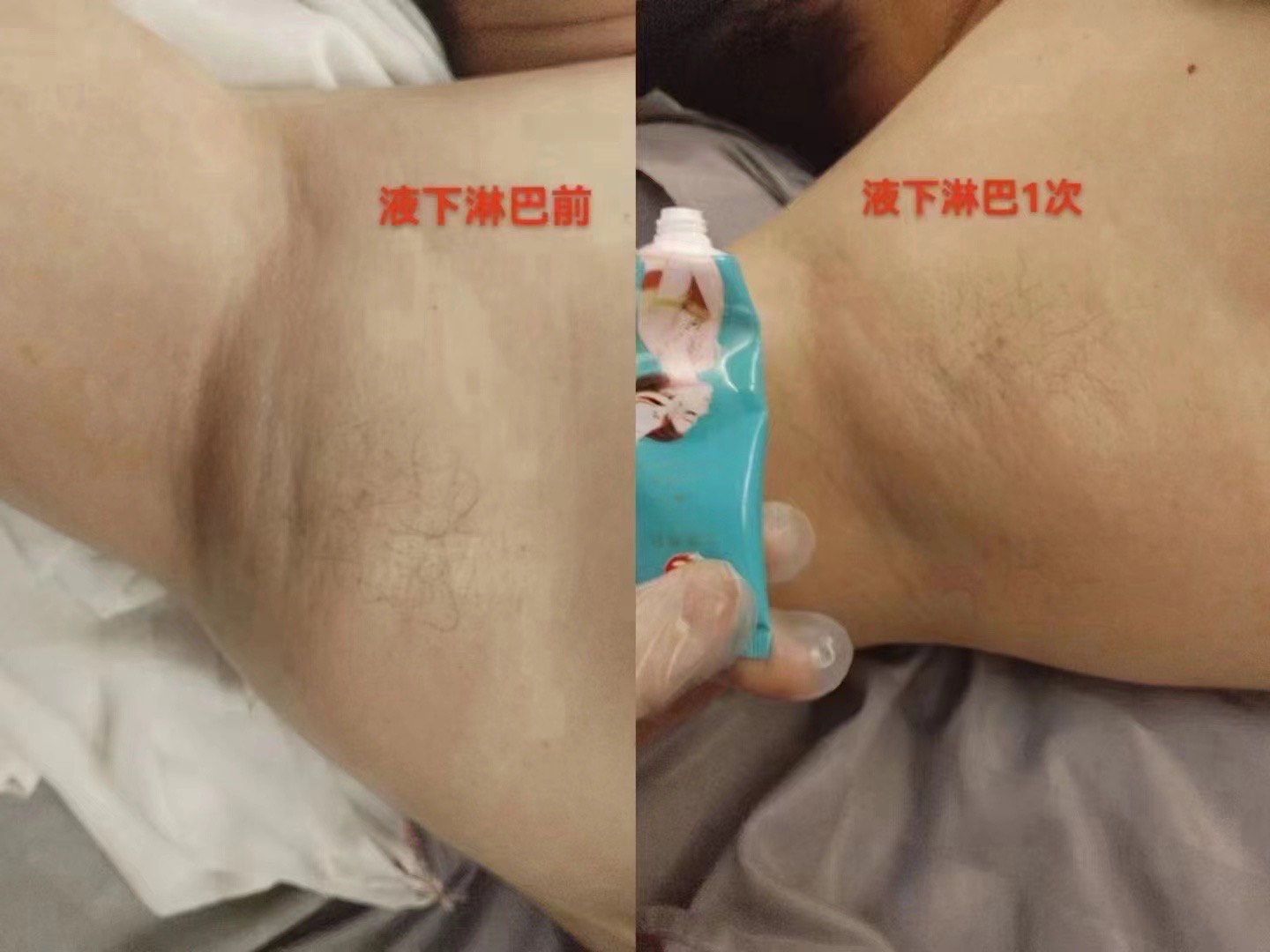 女性腋下淋巴堵塞图片图片