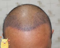 -大麦微针植发丨全国连锁