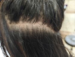 -碧莲盛·不剃发植发