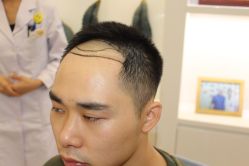 -大麦微针植发丨全国连锁