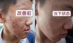 体验前-痘院长·祛痘·科技美肤