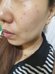 -北京美痣堂古方祛痣斑疣瘊