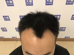 点击看大图 -大麦微针植发全国连锁