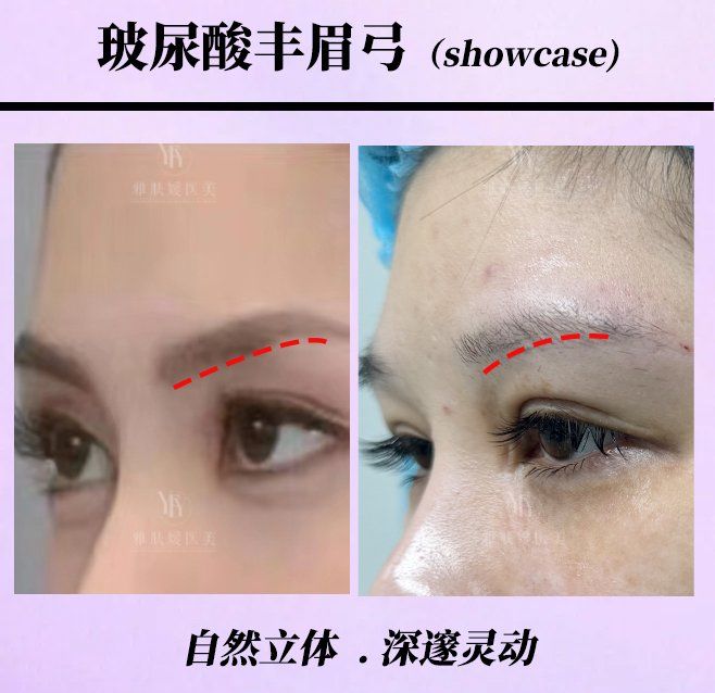 玻尿酸丰眉弓可行?