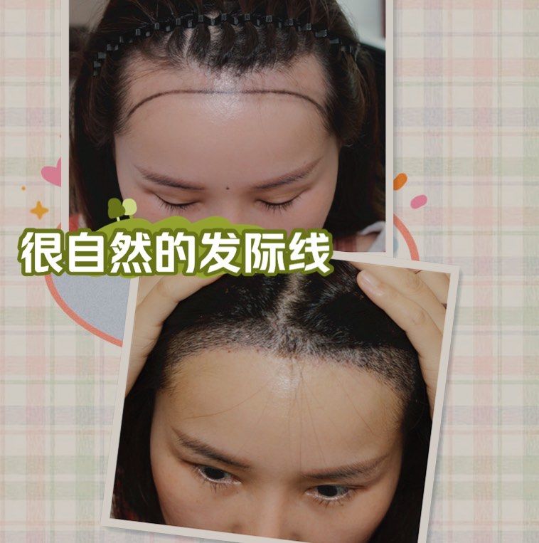 发际线的两个额角终于有头发了!