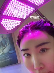 体验后-碧莲盛·不剃发植发