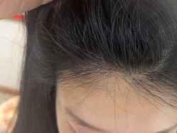 -碧莲盛·不剃发植发