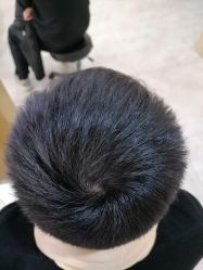 -大麦微针植发丨全国连锁