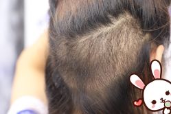 -大麦微针植发丨全国连锁