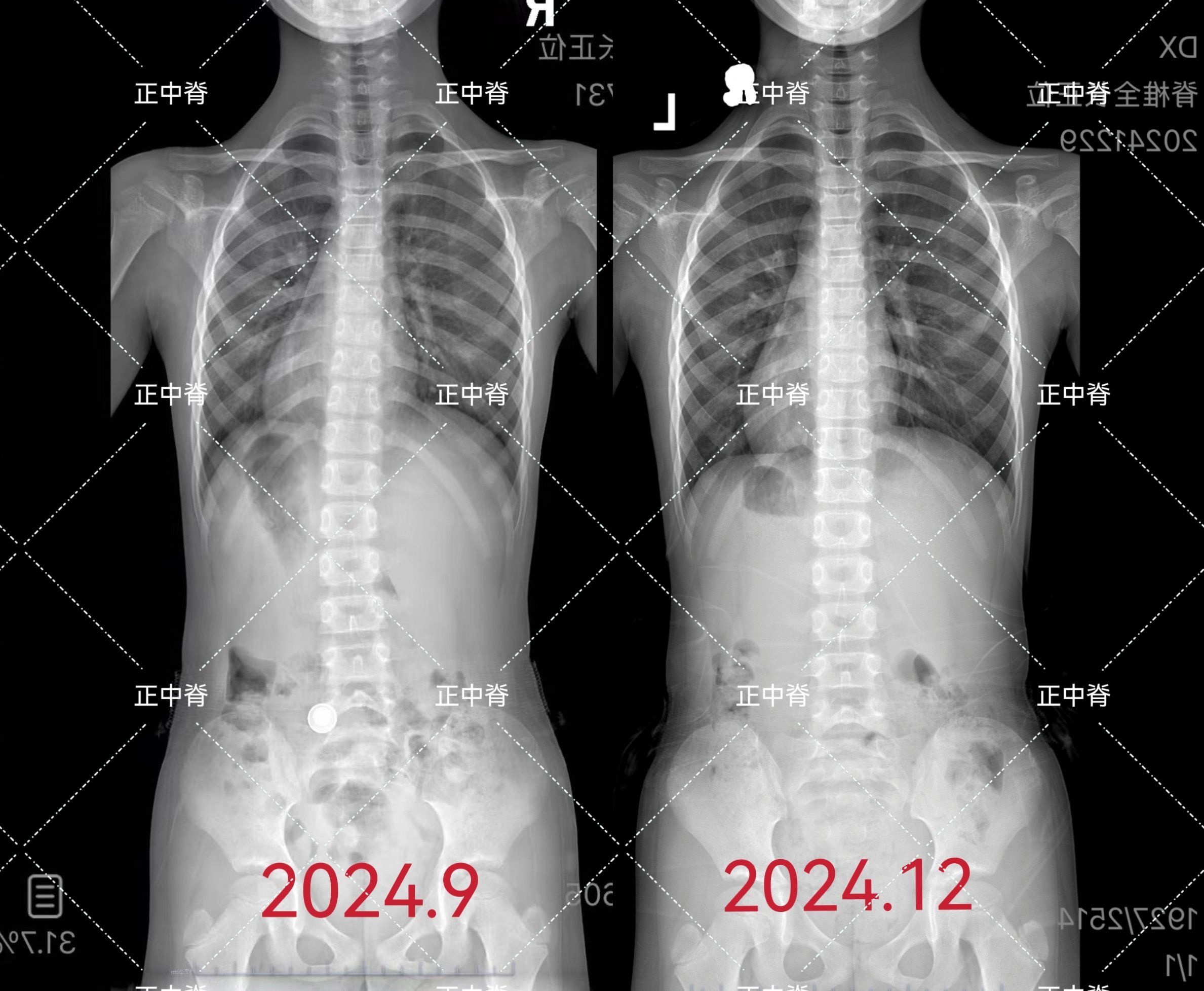成长轨迹:骨骼x光对比