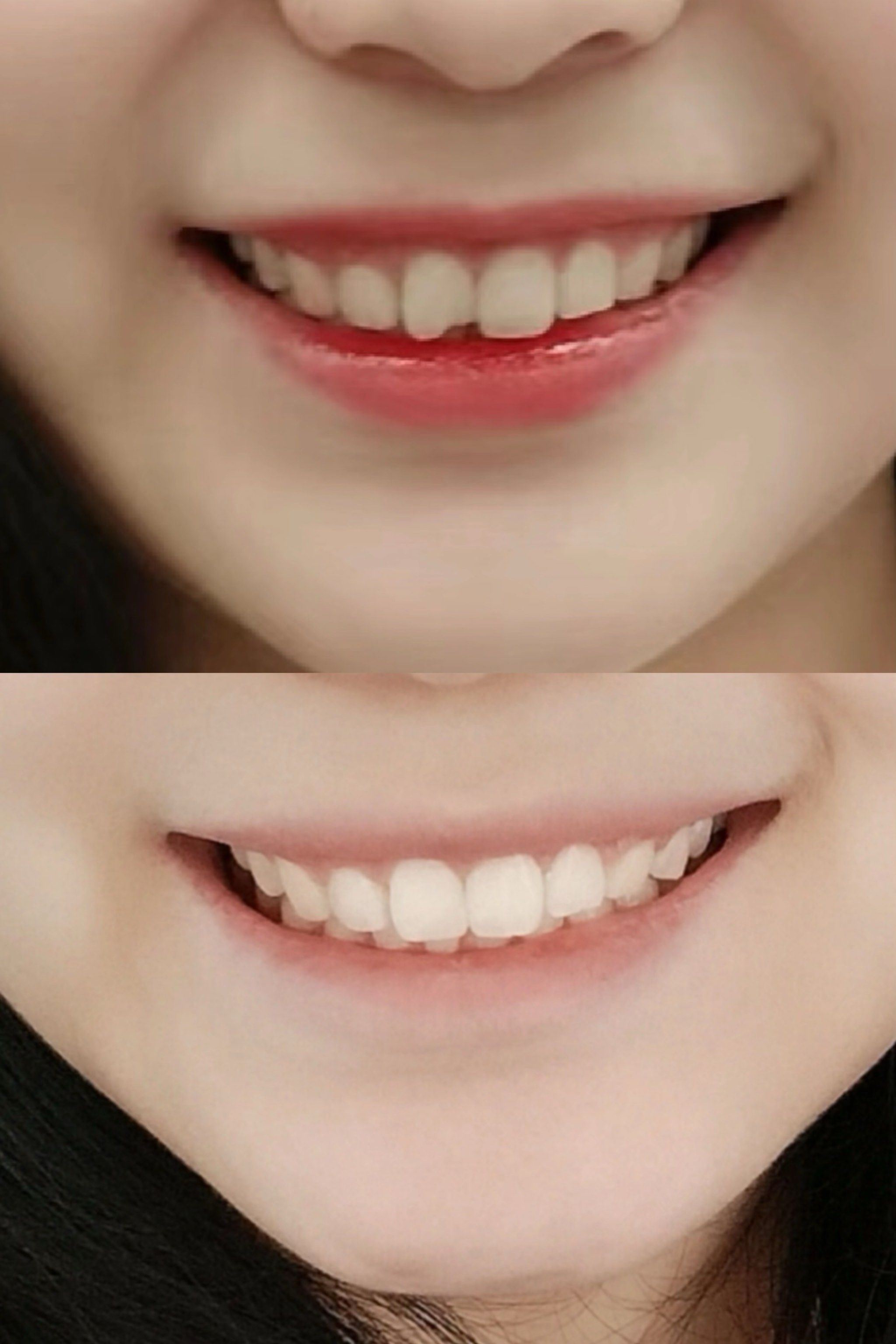 如何拥有好看的门牙