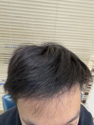 -大麦微针植发丨全国连锁