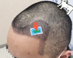 -大麦微针植发全国连锁