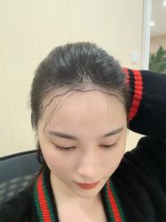 -碧莲盛·不剃发植发