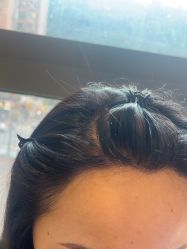 -碧莲盛·不剃发植发