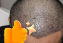 -大麦微针植发丨全国连锁