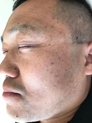 -美丽人生祛斑扁平疣汗管瘤中心