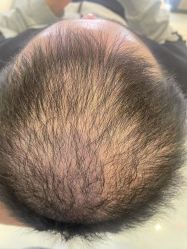 点击看大图 -大麦微针植发丨全国连锁