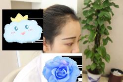 -大麦微针植发丨全国连锁