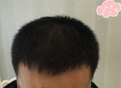 -大麦微针植发丨全国连锁