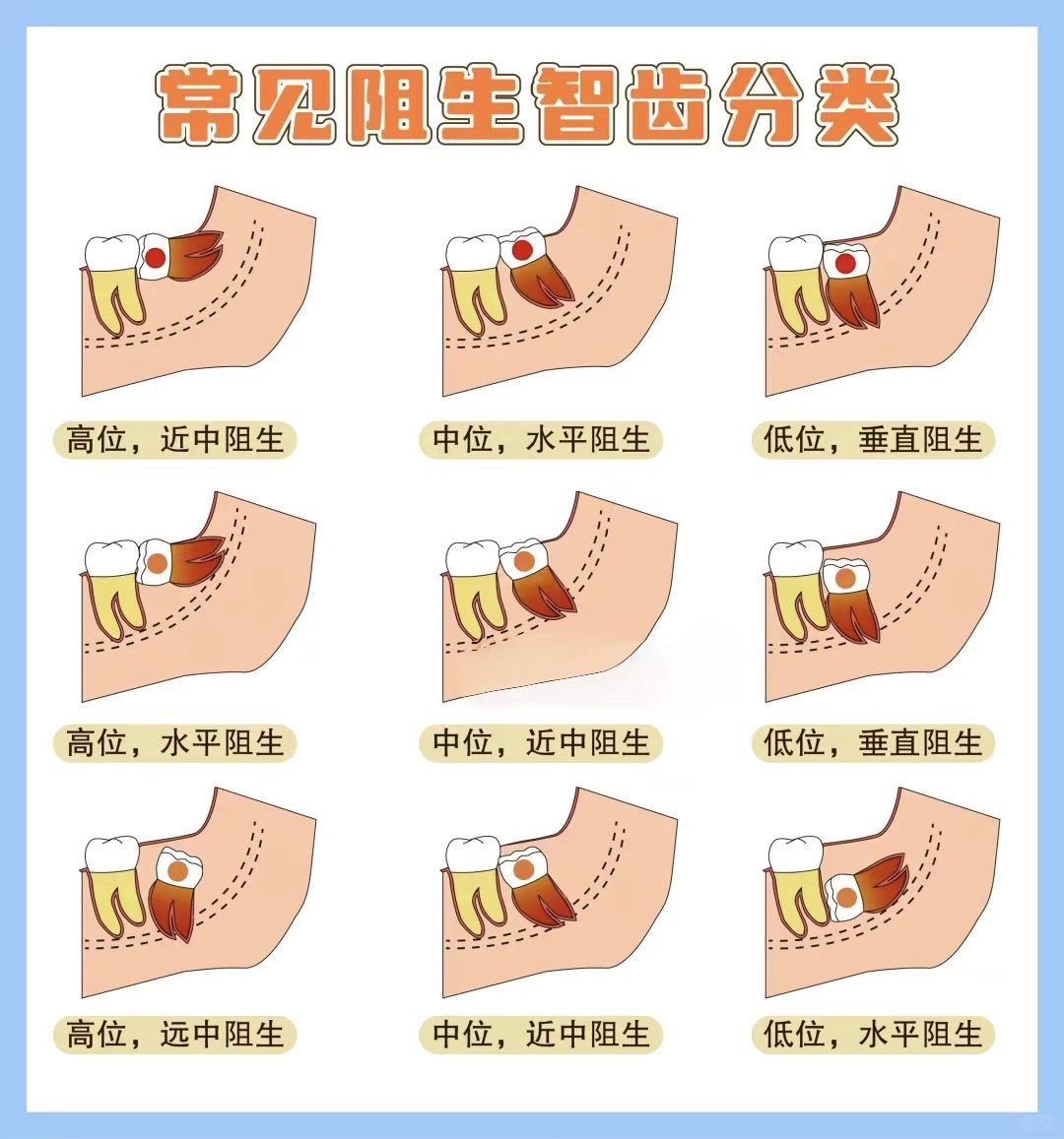 常见智齿分类