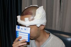 -大麦微针植发丨全国连锁