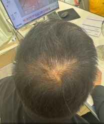 -碧莲盛·不剃发植发