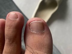 -祖传修脚甲沟炎灰指甲鸡眼