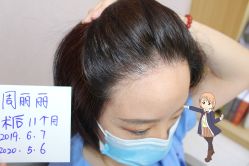 -大麦微针植发丨全国连锁