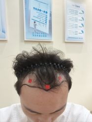 -大麦微针植发全国连锁