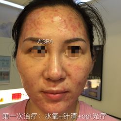 脸部抗衰-光SPA科技美肤