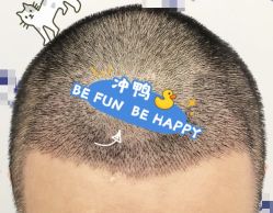 -大麦微针植发全国连锁