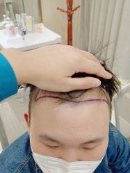 -碧莲盛·不剃发植发