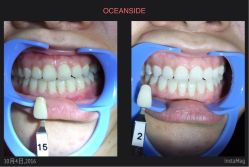 牙齿美白-光SPA科技美肤