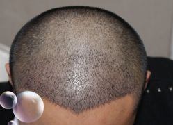 -大麦微针植发丨全国连锁