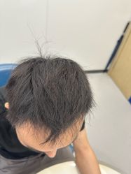 体验后-大麦微针植发全国连锁