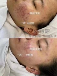 -蕾特恩专业祛痘