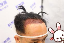 -大麦微针植发丨全国连锁