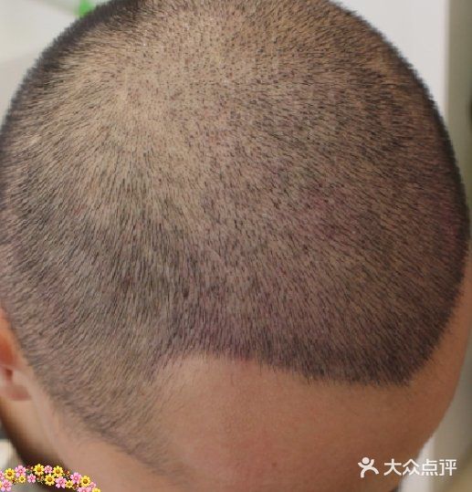 大麦微针植发丨全国连锁(宁波分院)图片