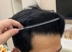 -大麦微针植发丨全国连锁