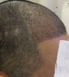 -大麦微针植发丨全国连锁