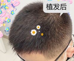 -大麦微针植发全国连锁