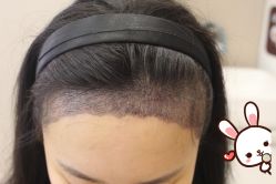 -大麦微针植发丨全国连锁