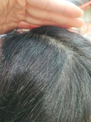 点击看大图 -碧莲盛·不剃发植发