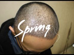 -大麦微针植发全国连锁